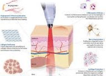 effect of laser.miini